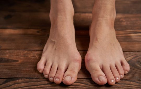 Comment soigner hallux valgus sans opération ?