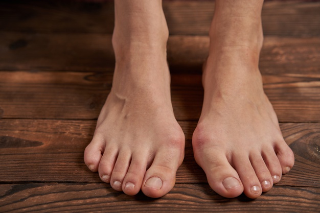 Comment soigner hallux valgus sans opération ?